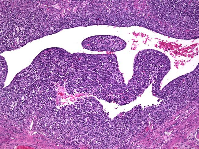 Juvenil ( cystisk) granulosacelletumor Celler med lite cytoplasma, irregulære, hyperkrom.