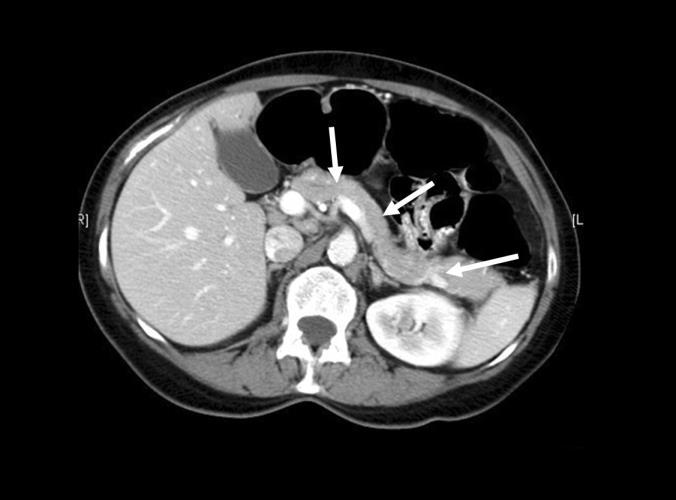 10 av 19 Spørsmål 1 (1 poeng) Bildet til venstre viser et normalt CT-bilde av abdomen sett i retning opp mot hodet (transversalt