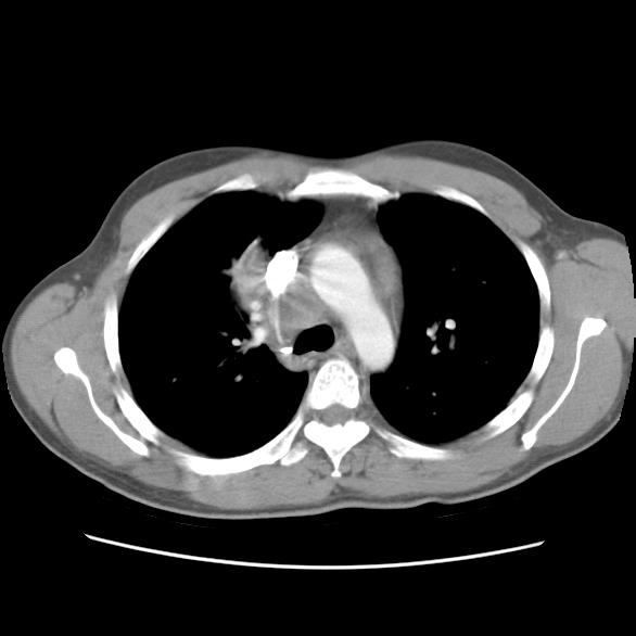 Kasustikk 3 CT-thorax: Forstørrede lymfeglandler (2.2 x 2.