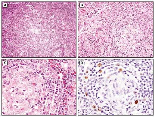 HHV-8-assosiert multicentrisk Castleman sykdom (A) Interfolliculære regioner er expandert med plasma celler og små lymphoid follikler.