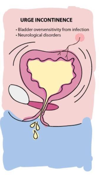 Først: type lekkasje? Urge / OAB - Overaktiv blære (OAB) +/- lekkasje - Hyppig vannlating & små volum - TRANG!