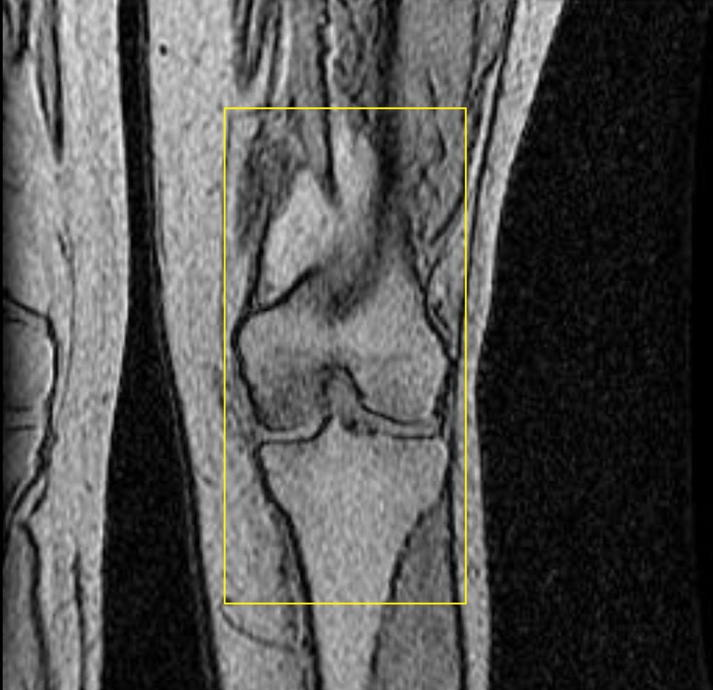 Alignment for the T1 Sagittal Body Coil Knee Scan Choose a coronal knee locator image showing the inferior condyles to be most prominent.