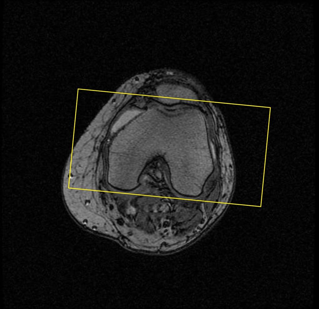 Alignment for the T1 Coronal Body Coil Knee Scan Using the Axial locator image, find the image showing the posterior condyles to be most prominent.