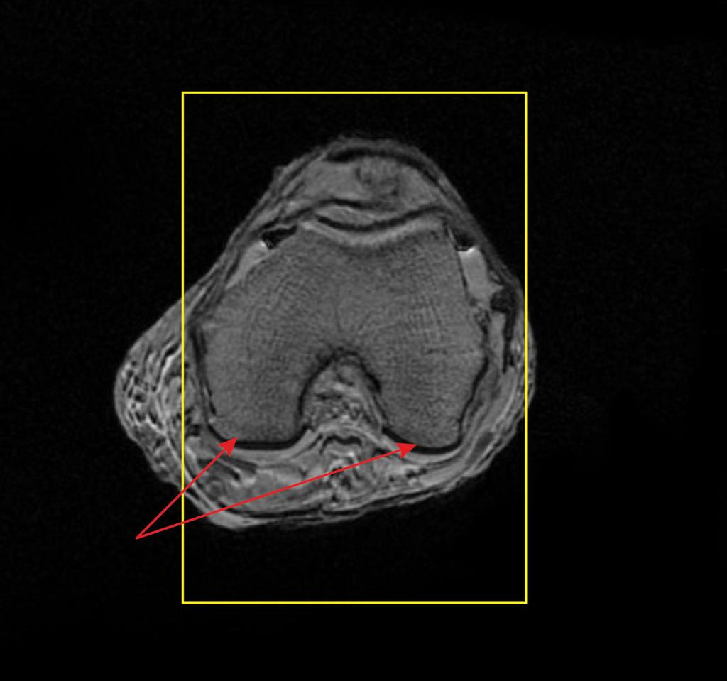 Positioning for Posterior Alignment Use your box shaped graphix. Follow the steps below for proper placement of slices. See Figures 1, 2, and 3.