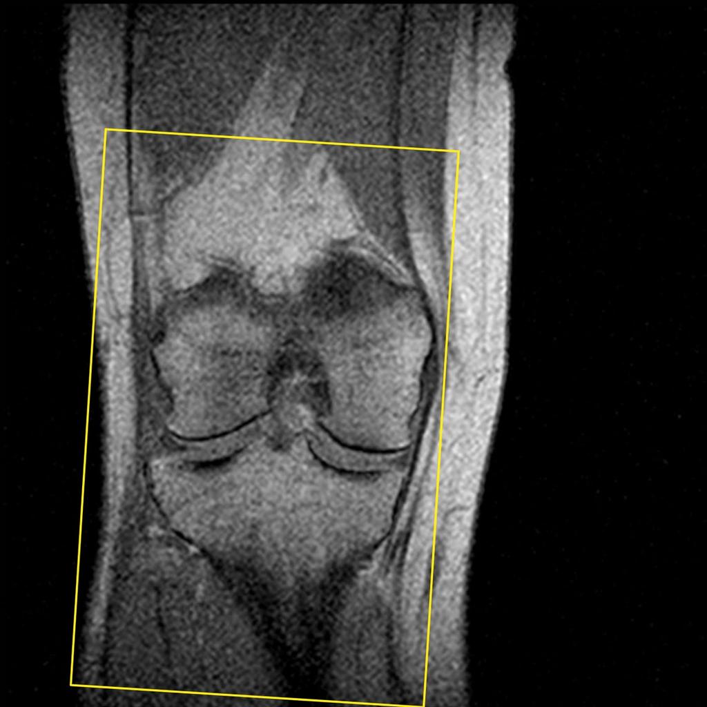 Figure 6 Move box to center slices over knee.