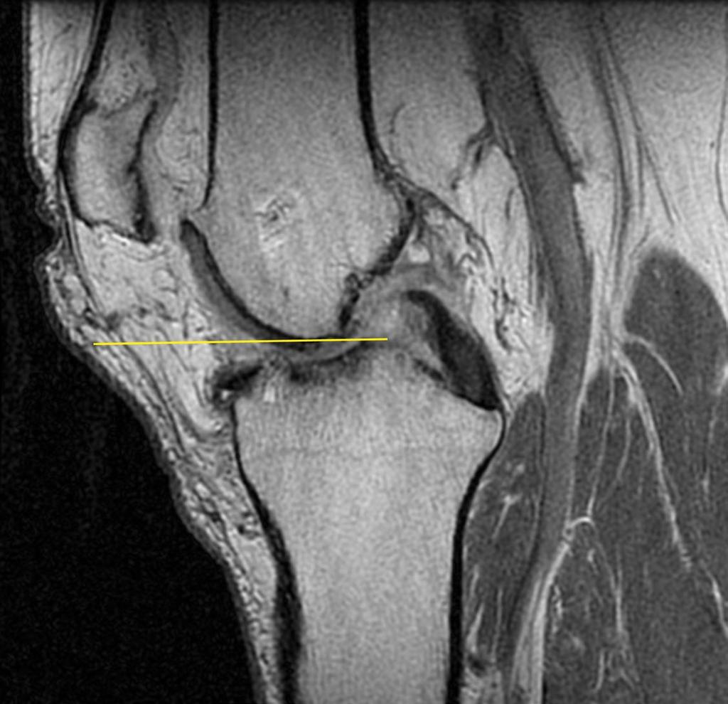 Centering 160mm FOV When viewing the Sagittal locator, center the FOV slightly below the point of the femur when viewing a mid-slice Sagittal image.