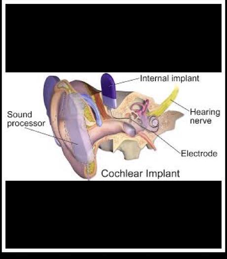 Oppsummering av lydens vei med Cochleaimplantat Lyd blir mottatt av mikrofonene i lydprosessor Lydprosessor omgjør akustiske signaler om til elektrisk signal og sender