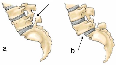 Ryggskader hos hoppere Stavhopp involverer overdreven strekk av ryggen, noe som gir en høy belastning på strukturene i ryggen.