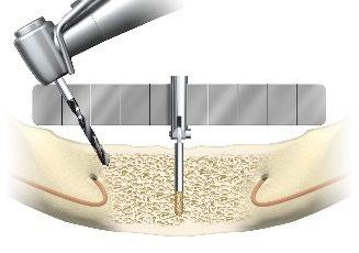 Depth Probe 7-18 mm Z-shaped: Depth Probe 7-18 mm Z-shaped er indisert for bruk under klargjøring av osteotomier for plassering av Nobel Biocare-implantater i over- eller underkjeve.