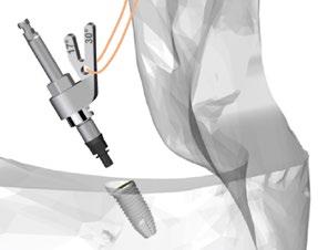 2. Sett montasjen bestående av implantatdriver og Multi-unit Aligning Instrument inn i implantatet (se figur E). Figur E: Innsetting av Multi-unit Aligning Instrument i implantat 3.