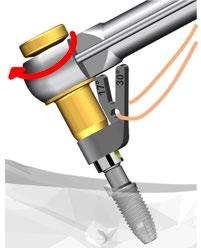 Mount eller Trefoil Implant Mount. I IFU2011 finner du mer informasjon om Guided Implant Mount, og i IFU1099 finner du informasjon om Trefoil Implant Mount. 1.