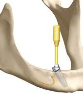 Figur K: Sikre retningsindikatoren med tanntråd 2. Etter osteotomien settes instrumentet inn i osteotomien for å bekrefte riktig orientering. Dybdemerkene på Direction Indicator Ø 2/Ø 2.4-2.