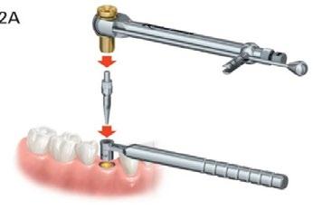 Koble Handle for Implant Rescue Collar and Drill Guides på Implant Rescue Collar, og koble den deretter til implantatets grensesnitt som vist på figur L.