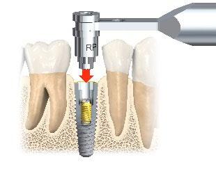 Figur M: Tilkobling av Handle for Implant Rescue Collar & Drill Guide på Rescue Drill Guide, og innsetting av Rescue Drill Guide i implantatkoblingens grensesnitt 2.