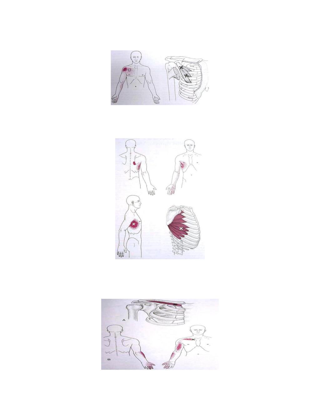 Pectoralis Minor Smerter i hele brystet, ofte i arm og hånd også http://www.triggerpoints.net/triggerpoints/pec-min.htm. Serratus Anterior Bryst føles unormalt følsomt.