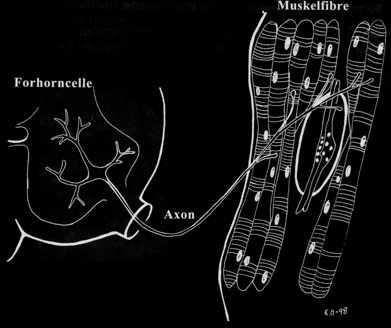 melser ikke diagnostiseres. En slik beskjeden lammelse kan gi senfølger i form av svakhet og muskelsmerte mange år senere.