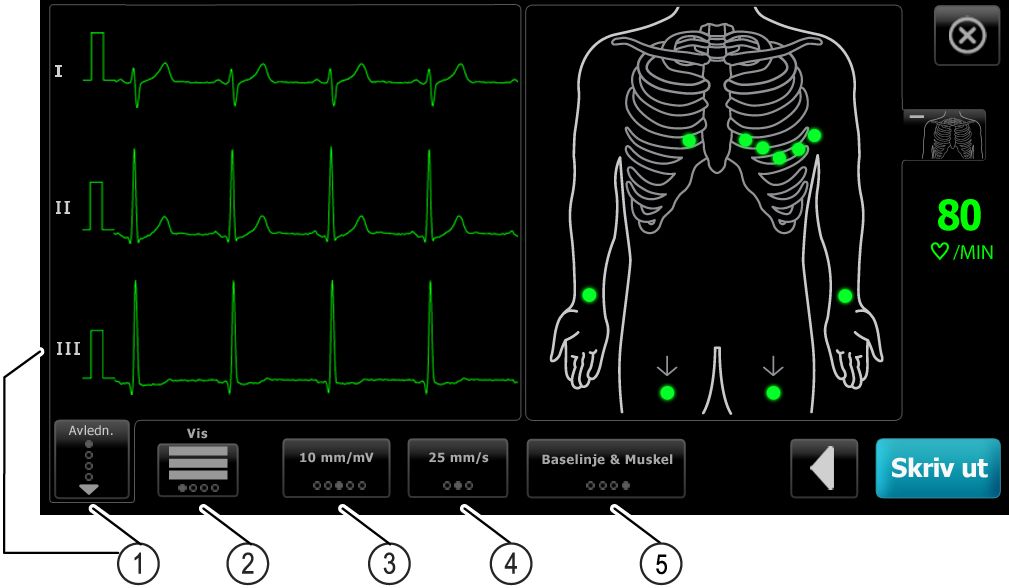 8 Utføre en auto-ekg-test CP 150 hvile-elektrokardiograf med 12 avledninger Komponent Knapp 1 Avledningsknapp 2 EKG-forhåndsvisningsknapp 3 Forsterkningsknapp (størrelse) 4 Hastighetsknapp 5