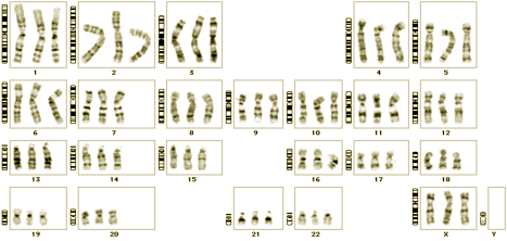 Fig. 8 Ideogram og triploid karyotype. 32 sjeldne kromosomavvik Noen endringer eller mutasjoner i kromosomene er så små at de rammer bare et eneste gen, og disse omtales som enkeltgenforandringer.