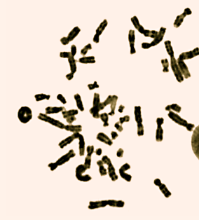 36 FIG 13 Ringkromosom. betegnelsen partiell monosomi. Delesjoner kan ramme en hvilken som helst del av et hvilket som helst kromosom.