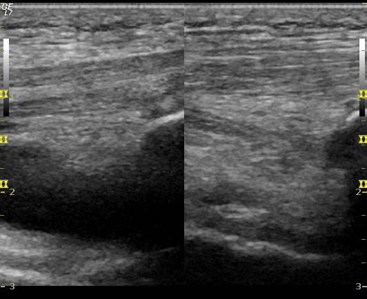 Kne Artritt/kapsulitt er en klinisk diagnose, men kan bekreftes på ultralyd hvor man som regel ser hevelse. Bilde 4 viser en tydelig hevelse over patella ve side (mørkt område).