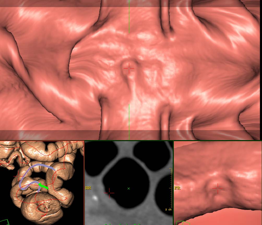 Minimere risiko Multisyke tømmes i sykehus/institusjon Laxobon ved nyresvikt CT-kolografi etter