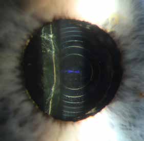 FAGARTIKLER Diffraktiv intraokulær linse. Merk ringene som skaper lesefokuset. Til venstre ses normale folder i bakre kapsel på dag 1 etter implantasjon. Samme øye som i bilde 2, men i rød refleks.