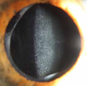 F PCO på baksiden av intraokulær linse i direkte belysning. Den grå sirkulære skyggen langs pupillkanten er åpningen i fremre linsekapsel som lages før implantasjon.