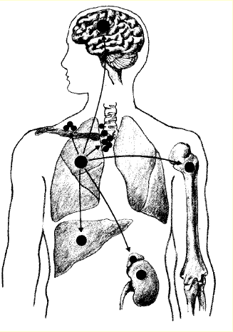 M-metastaser hjerne