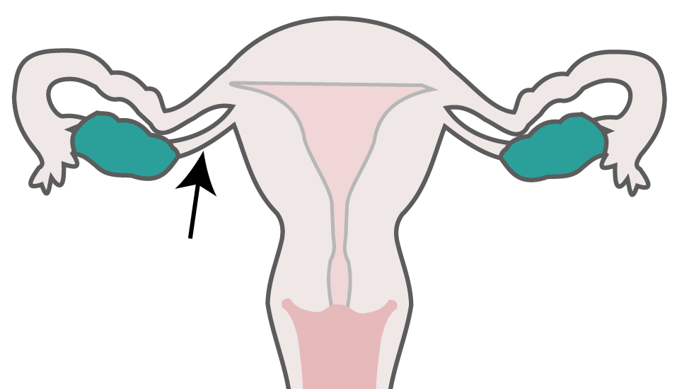 A Ramus ovaricus Lig. suspensorium ovarii Ampula tubae Lig.