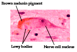 Lewy-body Den tyske legen Friedrich Lewy beskrev i 1912 mikroskopiske abnormale inklusjonslegemer i nerveceller i hjernen - derav navnet Lewy-body.