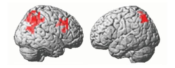 MRI activational changes: Increase in brain activity after