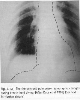 Virkninger av head-out immersion Økning av trykk-gradient abdomen-thorax Hydrostatisk ubalanse Effekter på væskebalanse Øket fylling av hjertet (250 ml) (diastolisk volum) Økning i hjertets