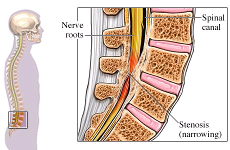 SPINAL STENOSE Spinal stenose betyr trang rygg og er betegnelsen på en forsnevring av den benete delen av spinalkanalen (ryggmargskanalen).