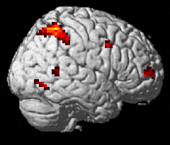 ... men andre aspekter ved hallusinasjoner, som oppmerksomhet og eksekutiv (kognitiv) kontroll sitter ikke i temporallappen Healthy control subjects Prefrontal cortex (PFC) Schizophrenia patients