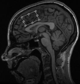 , PNAS, 2012 Systems (neuroimaging) Nevronal aktivering i anatomisk avgrensede områder og nettverk