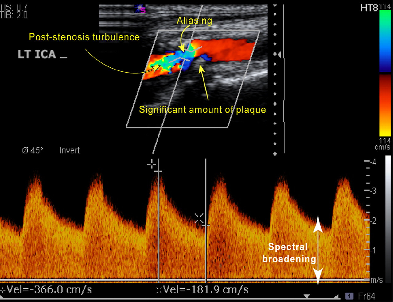 Konsensus - Ultralyd stenosegradering utifra hastighetsmål -RH Grant, Radiology 2003 Severe stenosis (70% to near occlusion) of the ICA. Tahmasebpour H R et al.