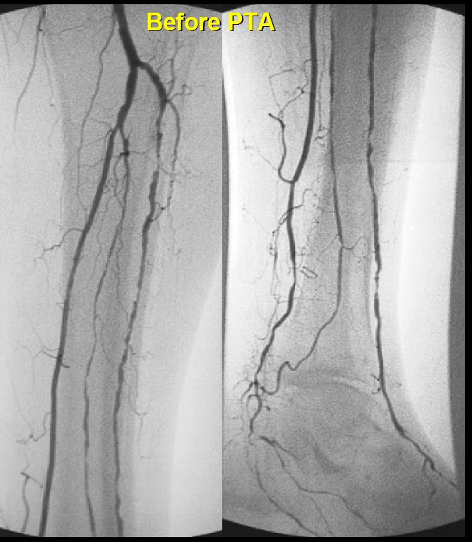 63 år M diabetiker. Ishemisk fotsår. Stenose i fibularis, tibialis anterior og posterieor. Prosedyre Antegrad instikk i lysken.