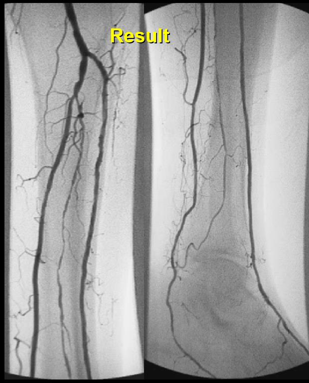 63 år M diabetiker. Ishemisk fotsår. Stenose i fibularis, tibialis anterior og posterieor.. Prosedyre Antegrad instikk i lysken.