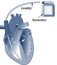 ICD - typer Kanne En kammer ICD A elektrode er festet i hø ventrikkel. Hvis nødvendig, leveres energi til ventrikkelen for å gjenopprette normale kontraksjoner.