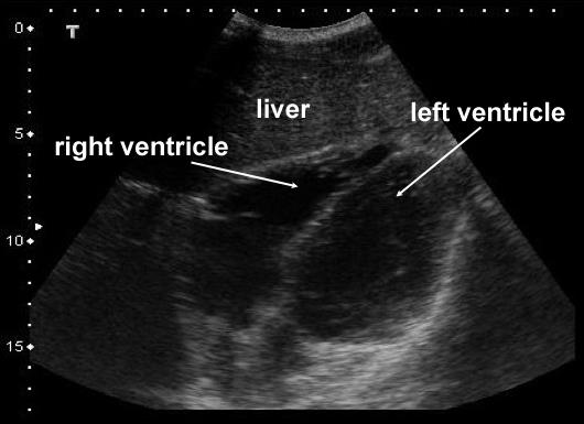 FAST focused assessment with sonography in trauma Målsetning: Deteksjon av fri væske