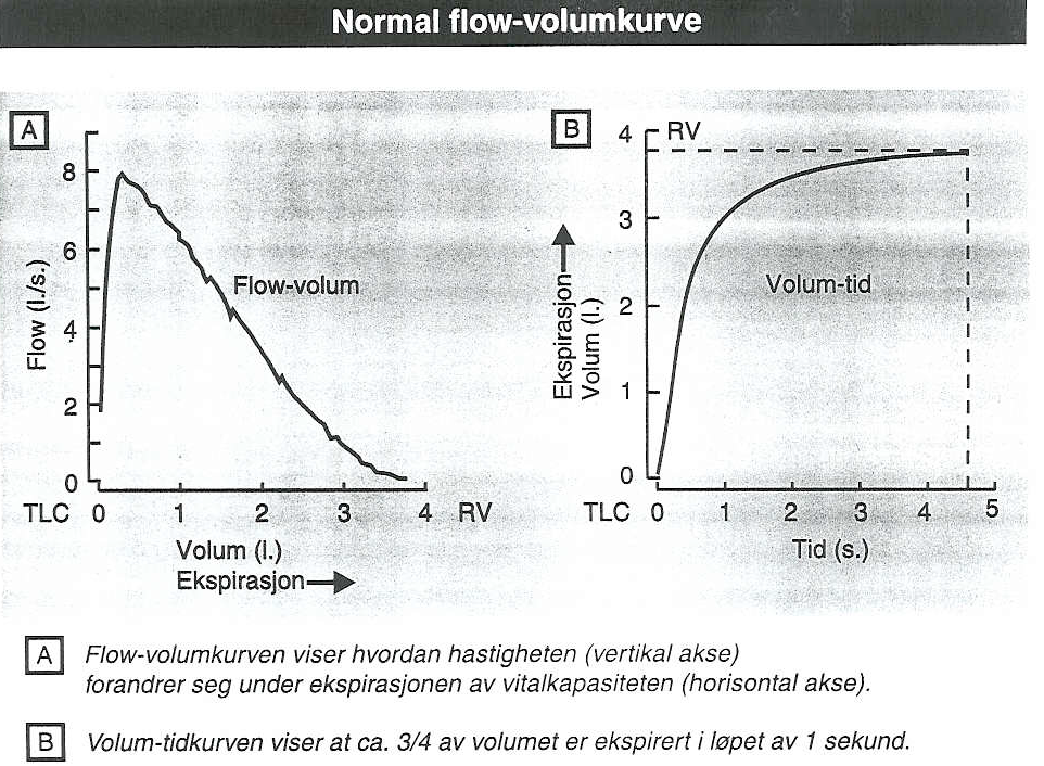 Normal Spirometri FEV1 > 80% av