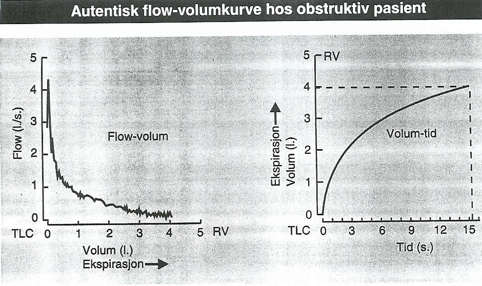 Obstruktiv spirometri FEV1 - kan være både normal og