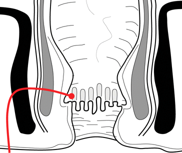 Grad 3 perianal fistel