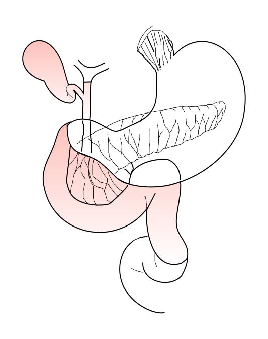 Den pylorusbevarende modifikasjonen ble lansert i 1978, og hypotesen var at denne metoden skulle gi bedre funksjonelle resultater på lengre sikt, mindre problemer med postoperative peroral ernæring,