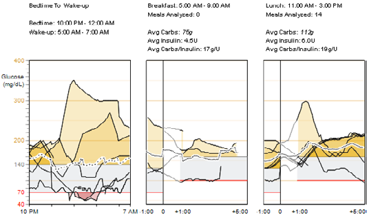 Overliggende verdier fra glukosesensor fra leggetid til morgen og måltidsperioder verdier og gjennomsnitt Følgende symboler brukes i grafene Bedtime to Wake-up (Fra leggetid til morgen) og Meal