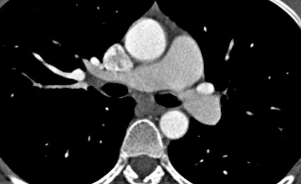 Rekonstruksjoner 2D MPR Orthogonale Oblique Doubleoblique Curved 3D SSD MIP MinIP Thin slice MIP VRT