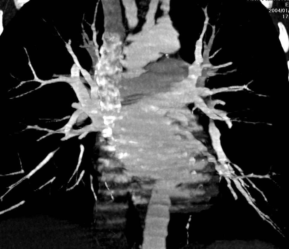 Rekonstruksjoner 2D MPR Orthogonale Oblique Doubleoblique Curved 3D SSD MIP MinIP Thin slice MIP VRT