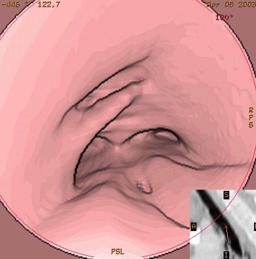 Rekonstruksjoner 2D MPR Orthogonale Oblique Doubleoblique Curved 3D SSD MIP MinIP