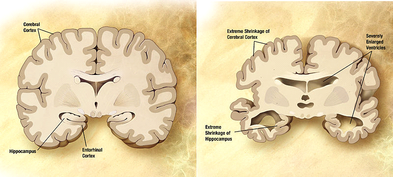 lösningen kan ha för samhället. Forskningsoppgave Vi valgte å jobbe med Alzheimers sykdom, fordi det ikke er noen kur mot det og intervjupersonen vår sa han har Alzheimer light.