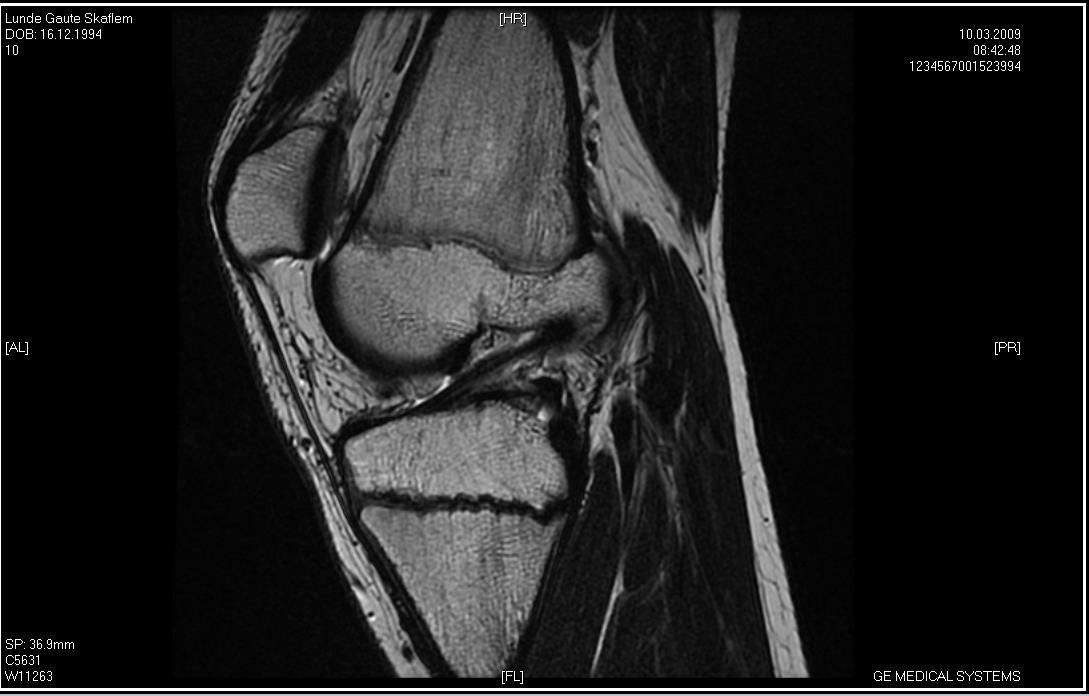 Kneskål (Patella) Lårben (Femur) Intakt